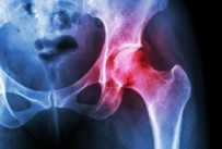 A common cause of groin pain