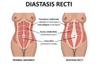 What Is Diastasis Recti And How PT Can Help?